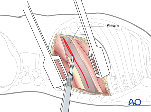 Thoracic and lumbar fractures: Left sided thoracotomy (T3-L1/2)