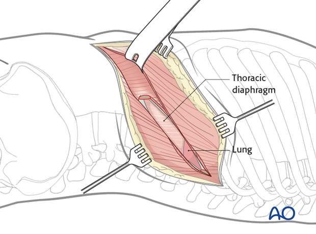 Thoracic and lumbar fractures: Left sided thoracolumbar junction approach (T10-L2) 