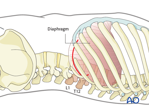 Thoracic and lumbar fractures: Left sided thoracolumbar junction approach (T10-L2) 