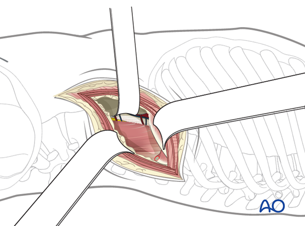 Thoracic and lumbar fractures: Left sided thoracolumbar junction approach (T10-L2)|alt