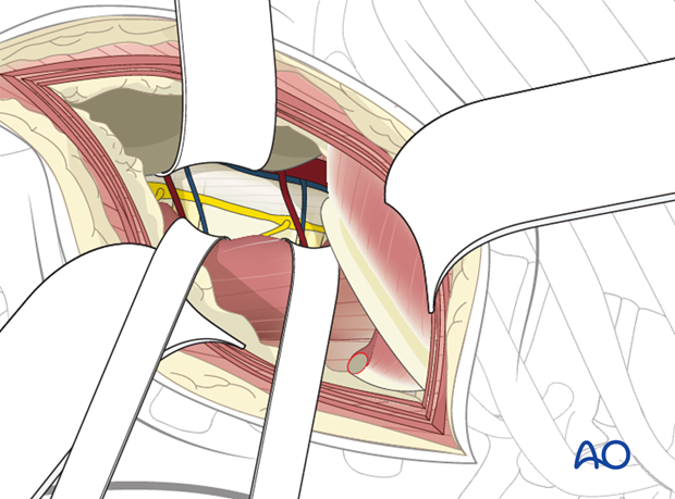 Thoracic and lumbar fractures: Lumbotomy (L1-L4)