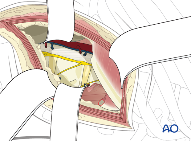 Thoracic and lumbar fractures: Lumbotomy (L1-L4)