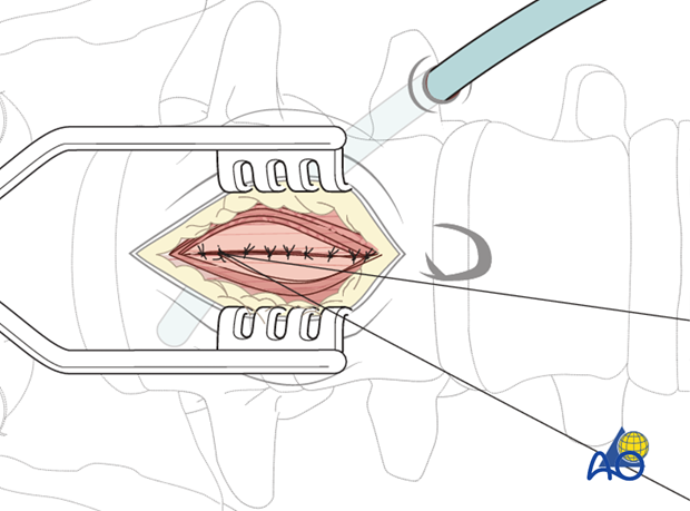 Thoracic and lumbar fractures: Mini open retroperitoneal approach (L4-S1)