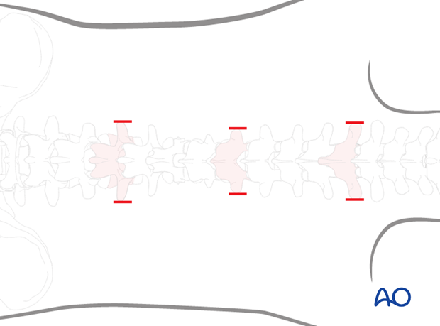 mis posterior short segment fixation with schanz pins