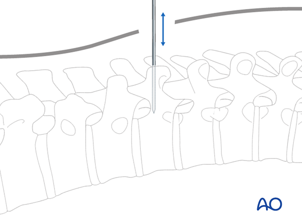 percutaneous posterior approach for pedicle screw placement