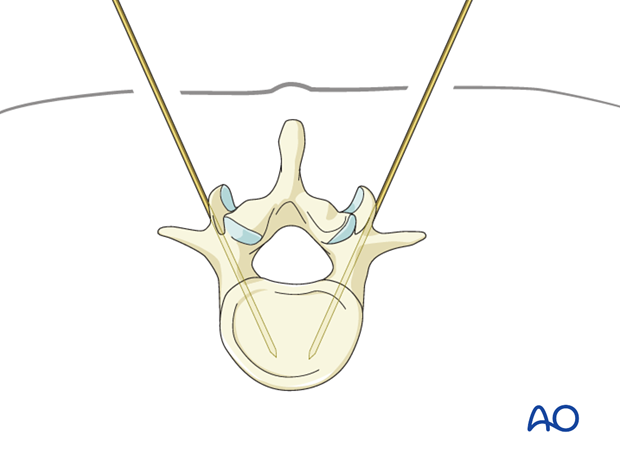 percutaneous posterior approach for pedicle screw placement