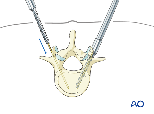 percutaneous posterior approach for pedicle screw placement