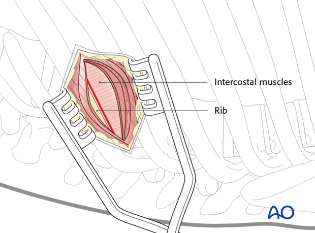 Thoracic and lumbar fractures: Minimally invasive left sided thoracic approach (T10-L2)