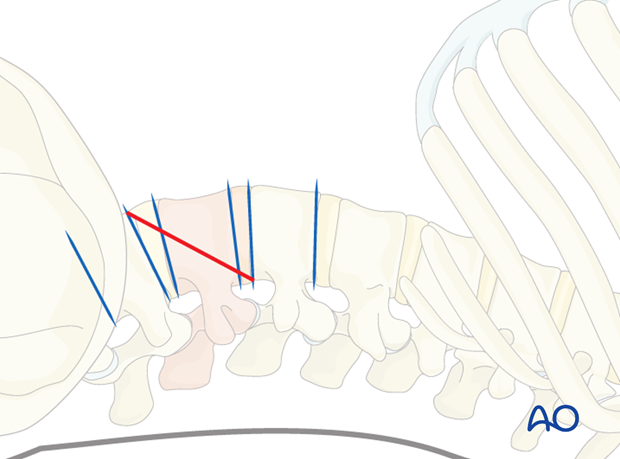 Thoracic and lumbar fractures: Minimally invasive lumbotomy (L2-L4)