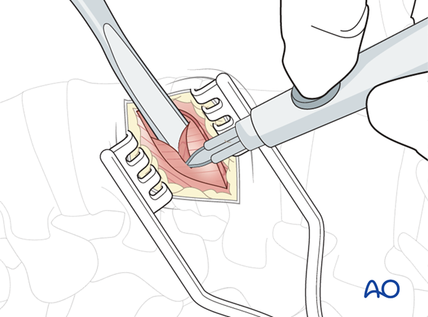 Thoracic and lumbar fractures: Minimally invasive lumbotomy (L2-L4)