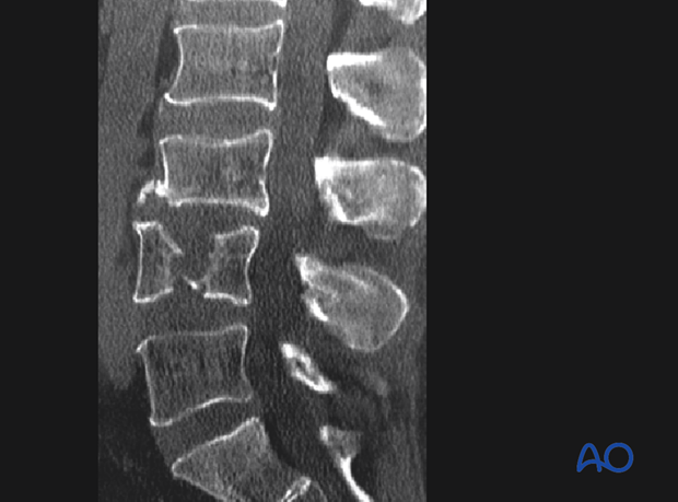 Diagnosis: X-ray/ CT, A2 - Split