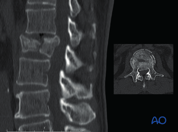 Diagnosis: X-ray/CT, A4 – Complete burst