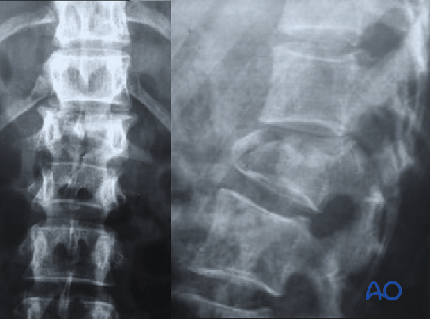 Diagnosis: X-ray/CT, B2 – Posterior tension band disruption