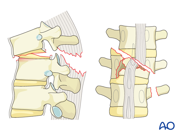 Diagnosis Thoracic and Lumbar Fractures: C – displacement or dislocation