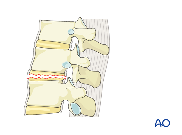 Thoracic and Lumbar Fractures: Rationale for fracture classification