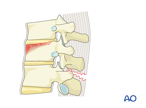 Diagnosis Thoracic and Lumbar Fractures: B2 – Posterior tension band disruption