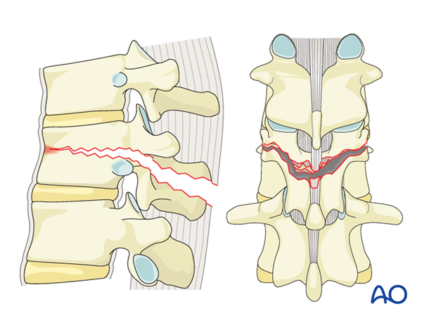 Thoracic and Lumbar Fractures: Rationale for fracture classification