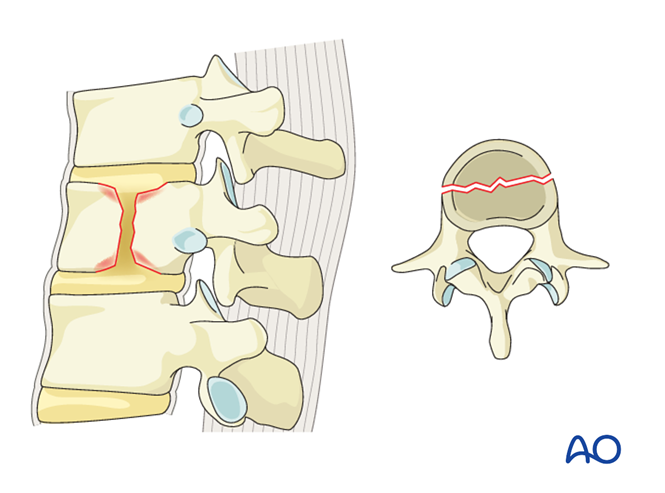 AO Spine thoracolumbar injury classification system