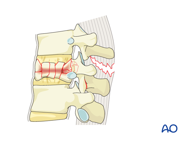 AO Spine thoracolumbar injury classification system