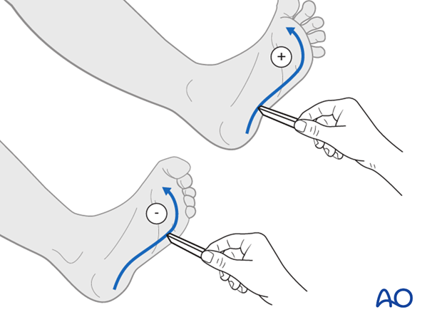 Thoracic and lumbar fractures: Patient examination - neurological evaluation