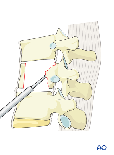 MIS Anterior stabilization for A2 - Split fractures