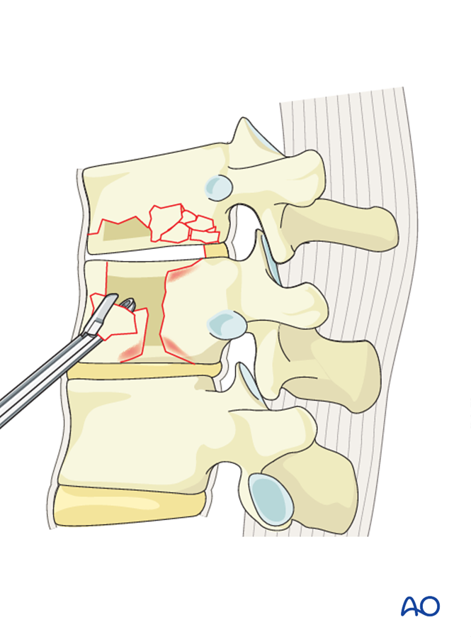 MIS Anterior stabilization for A2 - Split fractures