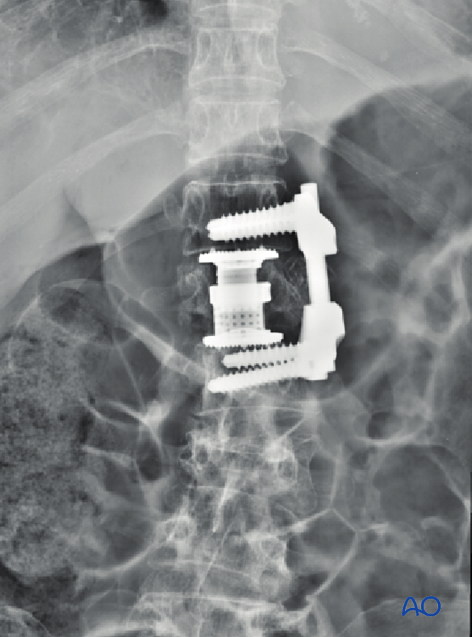 Anterior stabilization for A3 Incomplete burst fractures