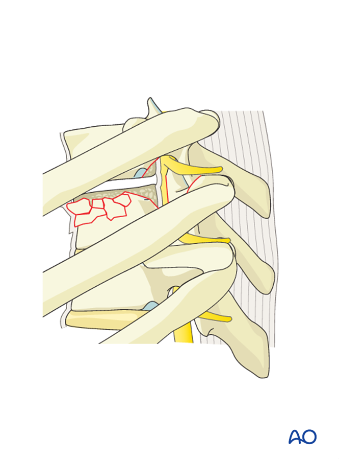 Anterior stabilization for A3 Incomplete burst fractures