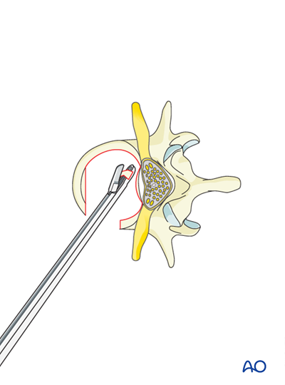 Anterior stabilization for A3 Incomplete burst fractures