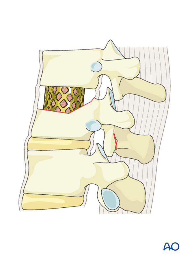 Anterior stabilization for A3 Incomplete burst fractures