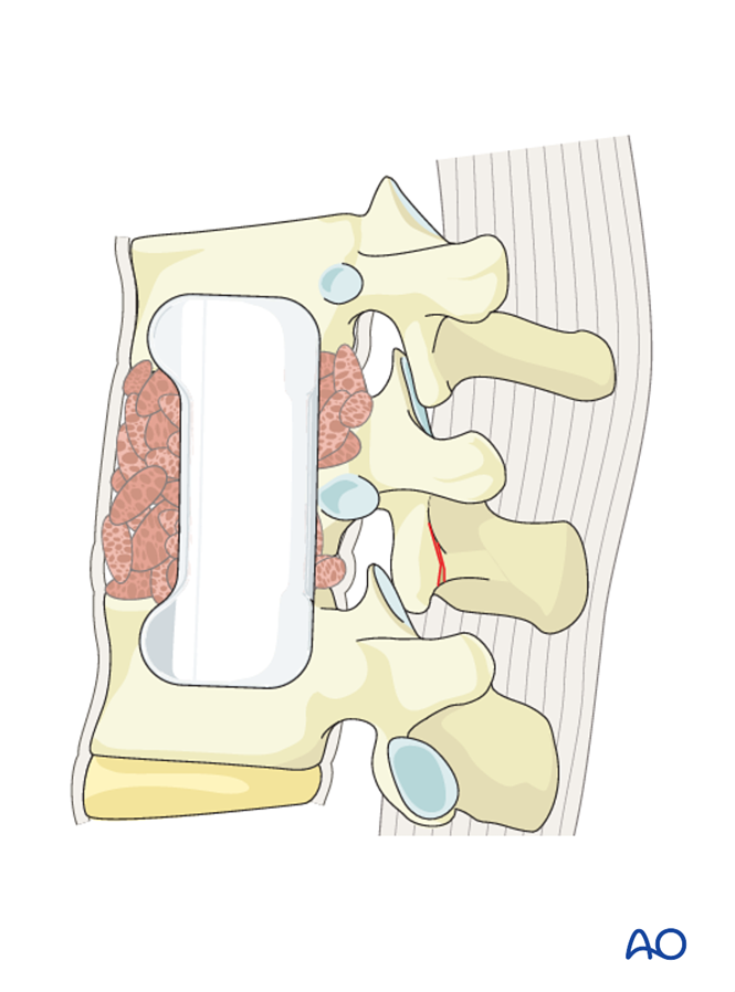 Anterior stabilization for A3 Incomplete burst fractures