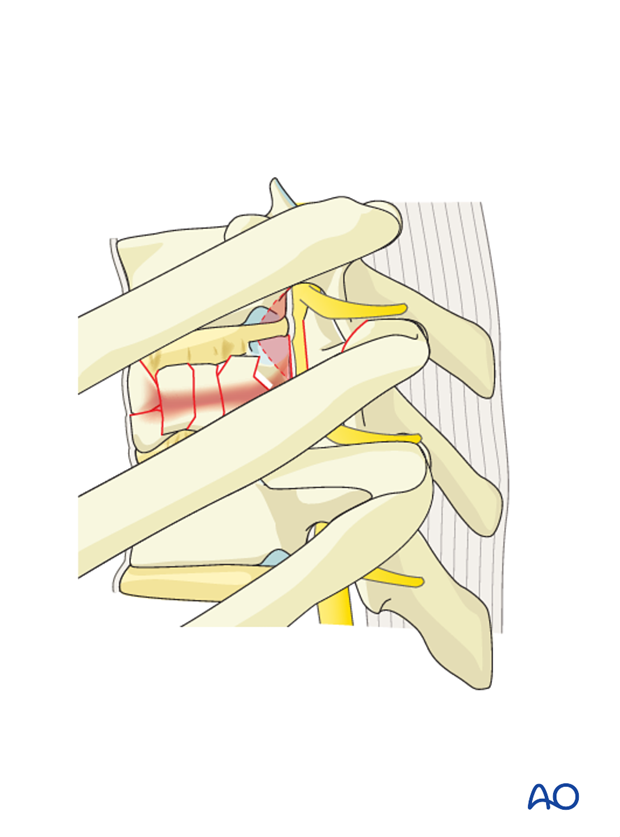 Thoracic and lumbar fractures: Anterior stabilization