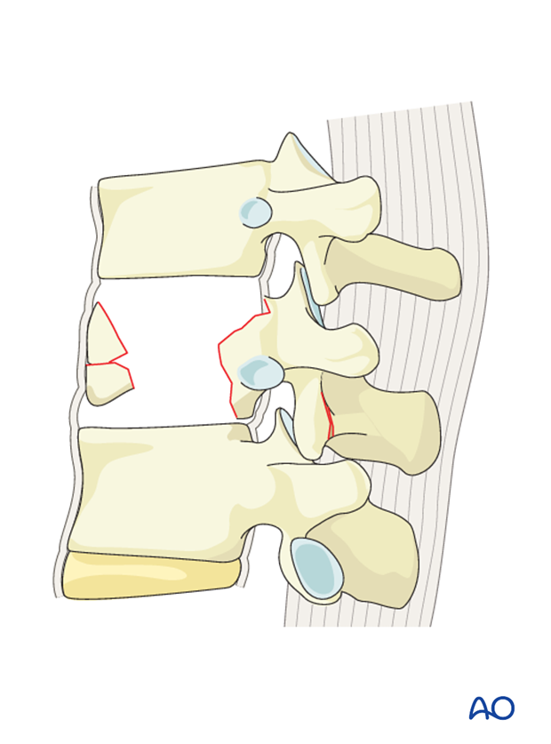 Thoracic and lumbar fractures: Anterior stabilization
