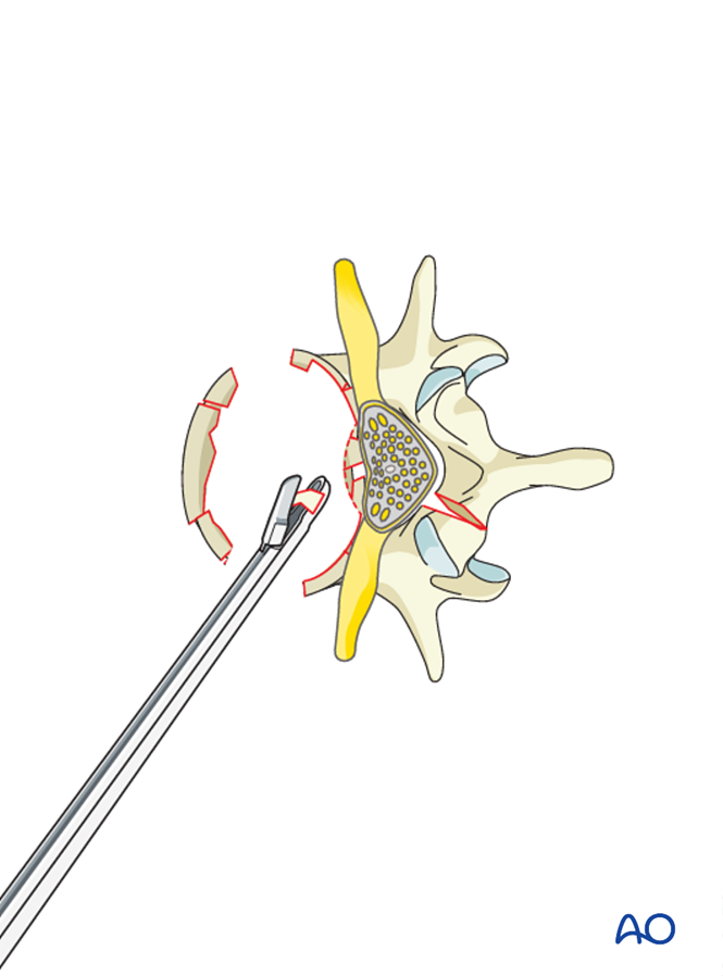 MIS Anterior Stabilization for A4 Complete burst fractures