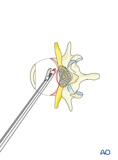 Anterior stabilization for B2 Posterior tension band disruption