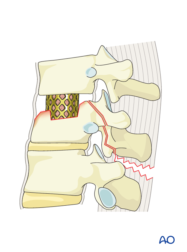 Thoracic and lumbar fractures: Anterior stabilization