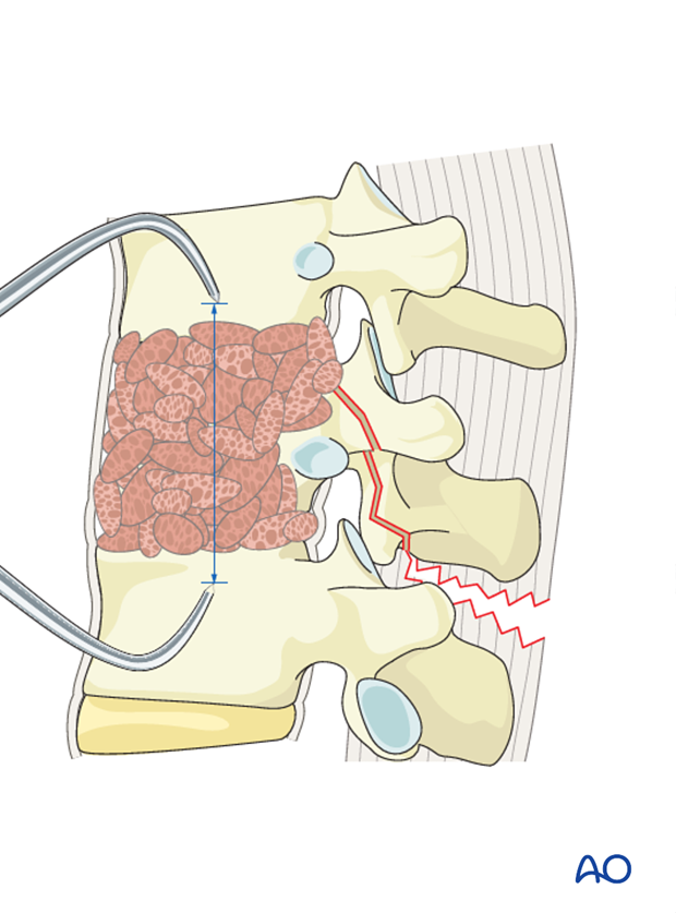 Thoracic and lumbar fractures: Anterior stabilization