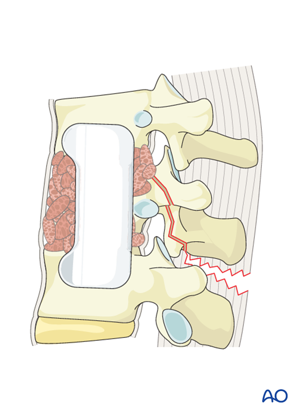 Thoracic and lumbar fractures: Anterior stabilization