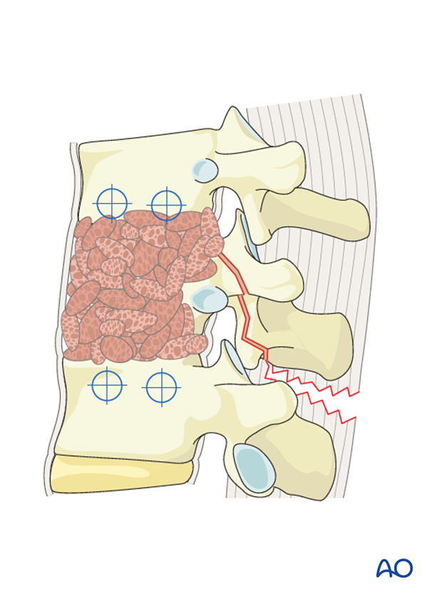 Thoracic and lumbar fractures: Anterior stabilization