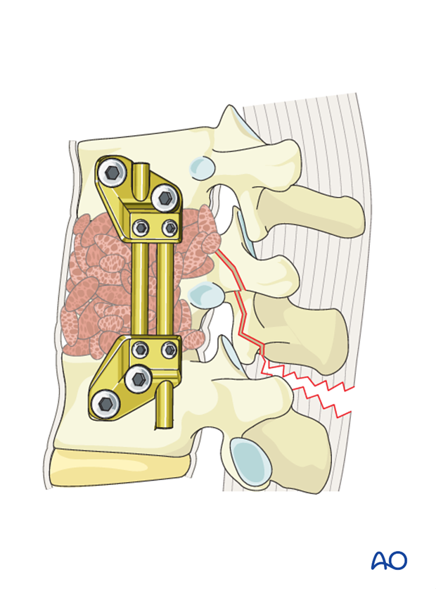 Thoracic and lumbar fractures: Anterior stabilization