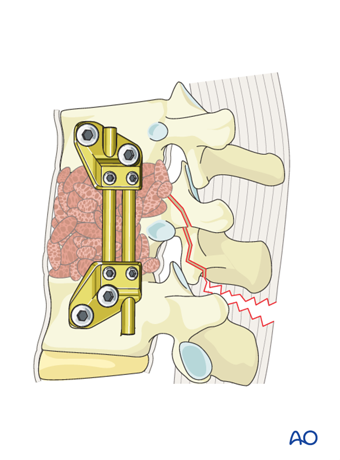 Anterior stabilization for B2 Posterior tension band disruption