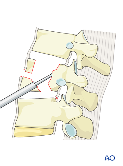 Anterior stabilization for B3 Hyperextension