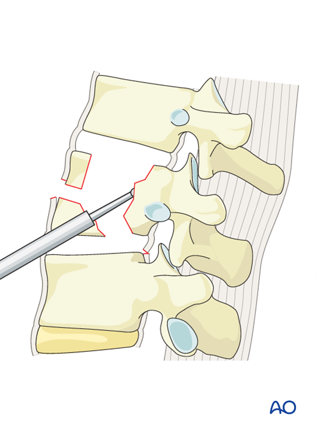 Thoracic and lumbar fractures: Anterior stabilization