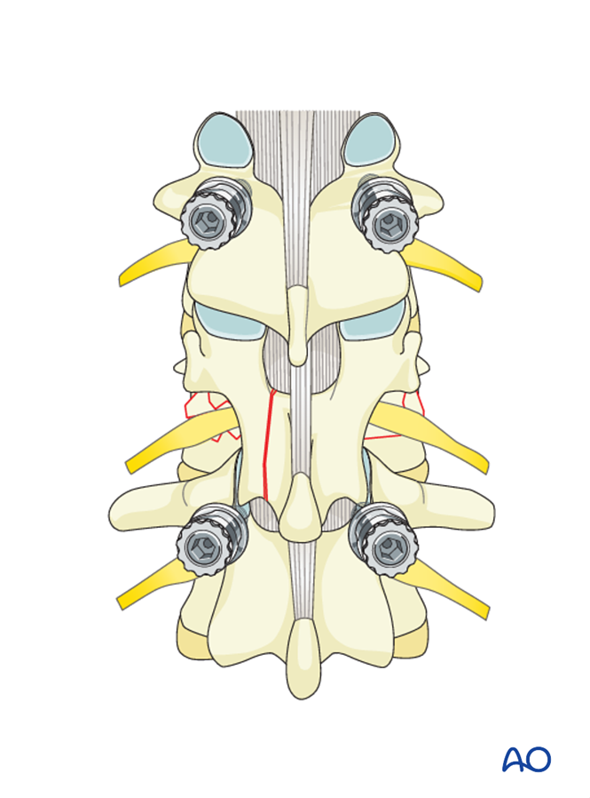 Posterior short segment fixation with pedicle screws for A3 Incomplete ...