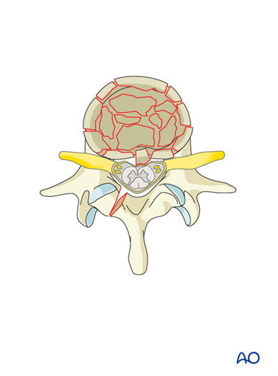 Posterior short segment fixation with Schanz pins for A3 Incomplete ...