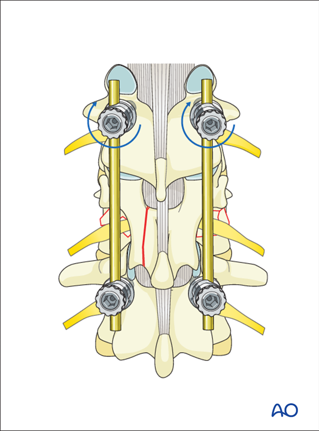 Thoracic and lumbar fractures: Posterior short segment fixation with pedicle screws