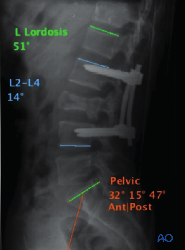 Thoracic and lumbar fractures: MIS posterior short segment fixation with pedicle screws