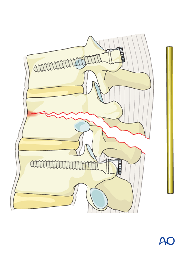 Thoracic and lumbar fractures: Posterior short segment fixation with pedicle screws