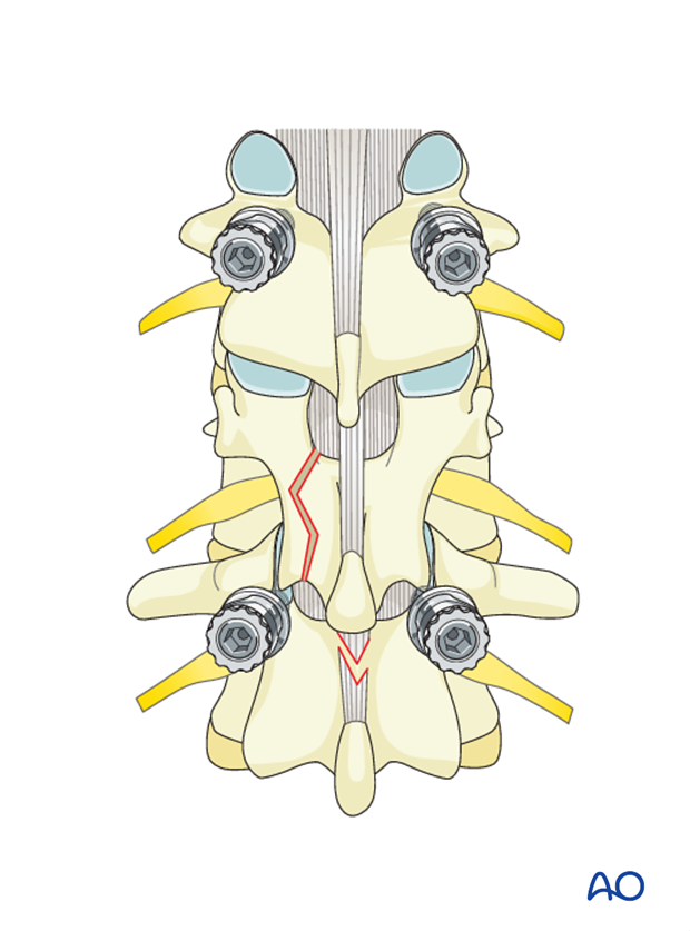 Thoracic and lumbar fractures: Posterior short segment fixation with pedicle screws