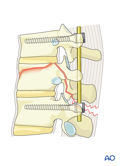 MIS posterior short segment fixation with pedicle screws for B2 ...